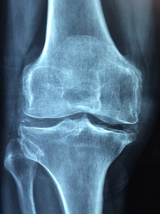 Illustration for article titled Whatever the Situation or Activity, Joint Injuries Can Rarely be Ruled Out